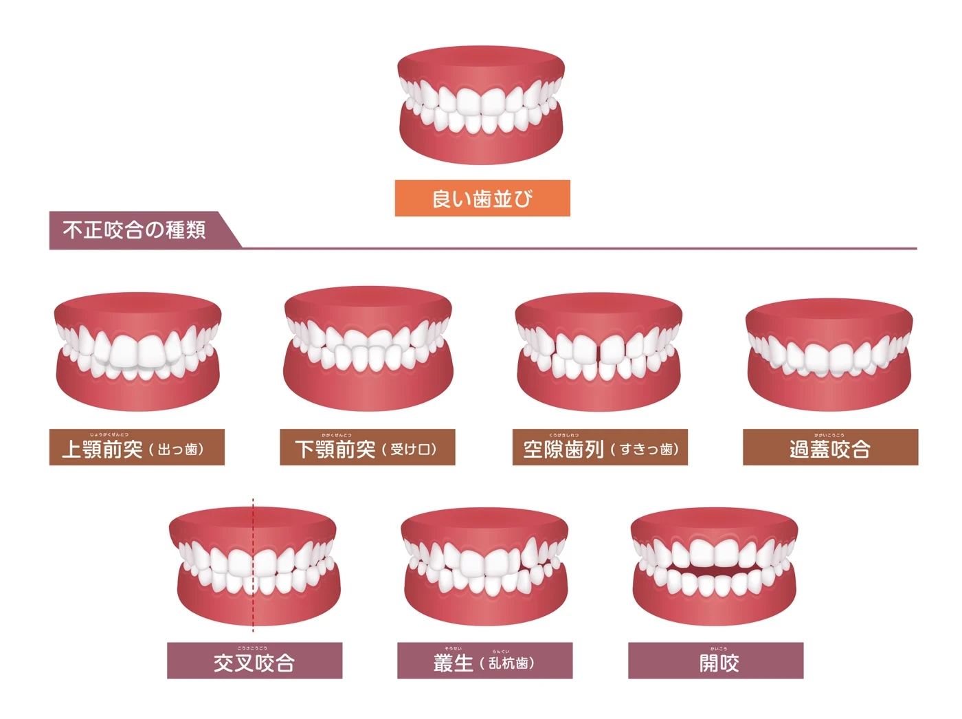 歯並びはどこまで許せる？矯正が必要なラインとは【日本歯科札幌院長が解説！】の参考画像
