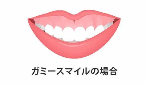 ガミースマイル矯正で悪化って本当?原因と対策を徹底解説!【静岡歯科が解説!】の参考画像