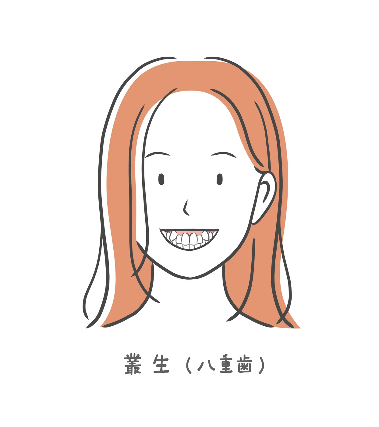八重歯は部分矯正できない?全体矯正が必要なケースを解説します【日本歯科札幌院長が解説!】の参考画像