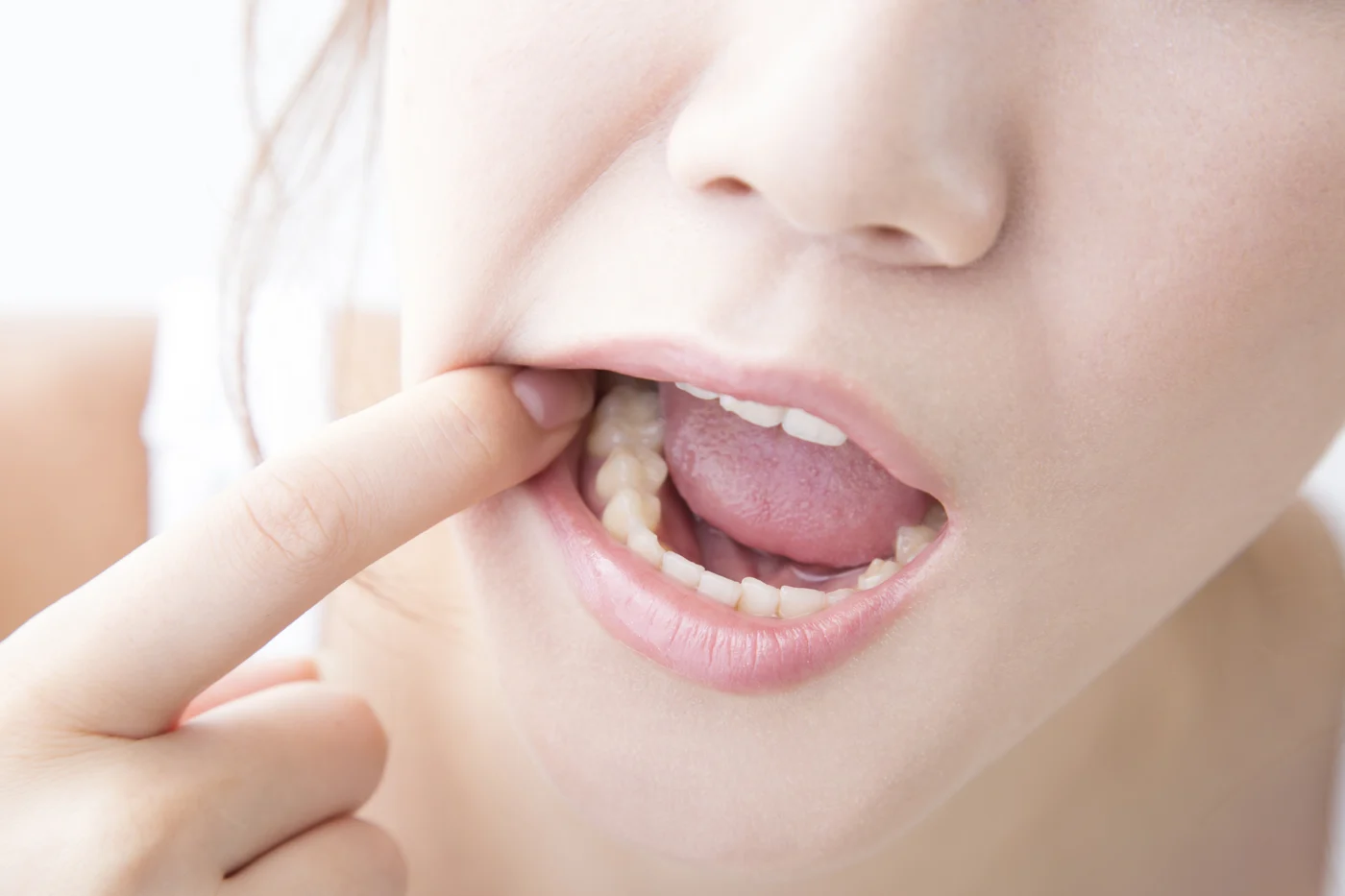 矯正治療で歯茎が下がる原因と予防策を解説！健康な歯茎を保つには？【日本歯科札幌院長が解説！】の参考画像