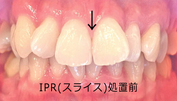 20代女性Aのマウスピース矯正(治療スタート):治療前