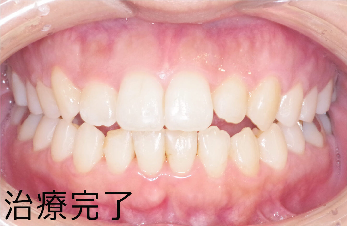 30代女性Dのマウスピース矯正(終了):治療後
